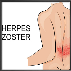 Herpes Zoster